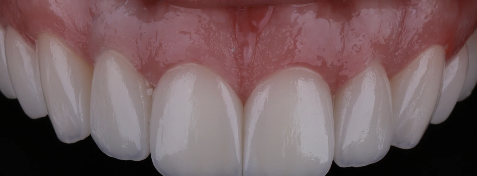 Reabilitação de dentes anteriores superiores em resina composta