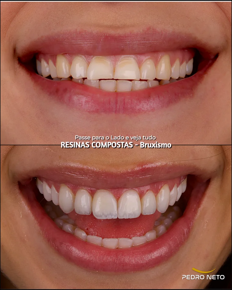 Antes e depois — Bruxismo
