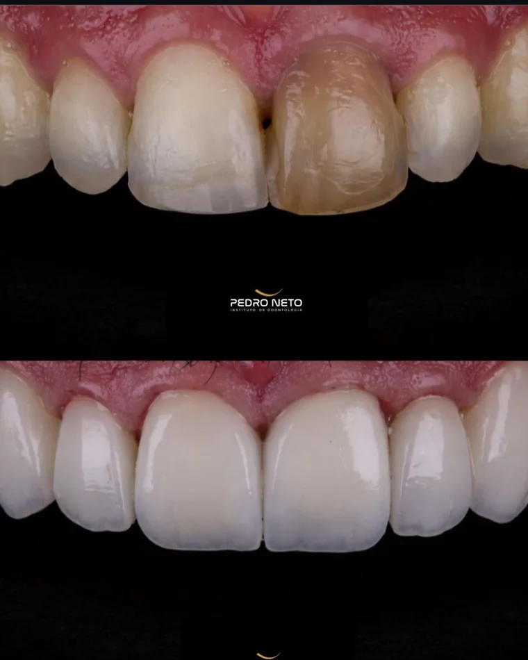 Antes e depois — Dente escurecido