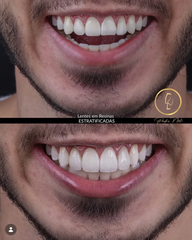 Antes e depois — 6 elementos em resina estratificada