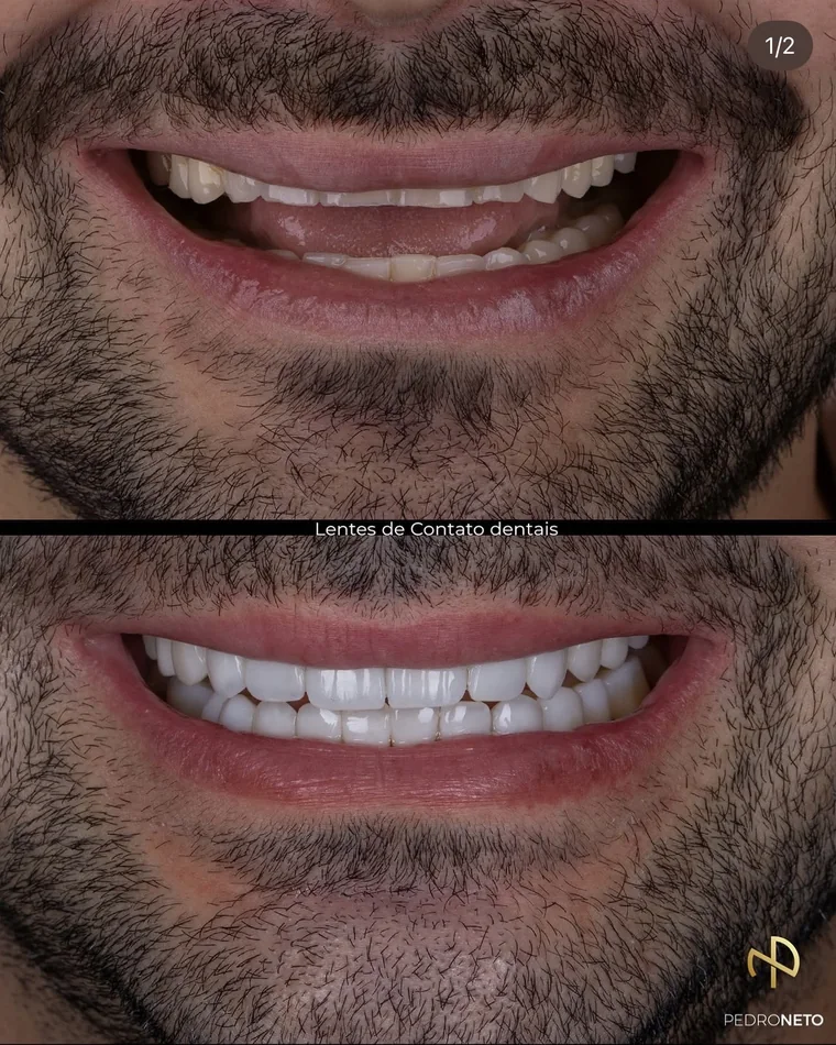 Antes e depois — Bruxismo severo, reabilitação em resina