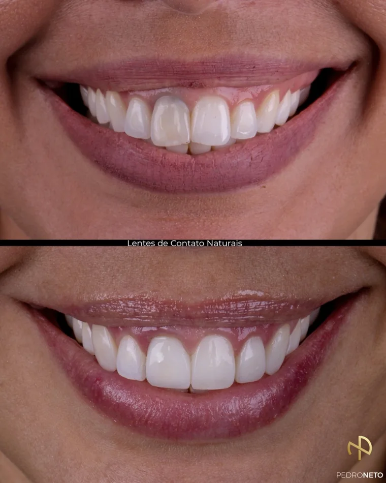 Antes e depois — Central escurecido