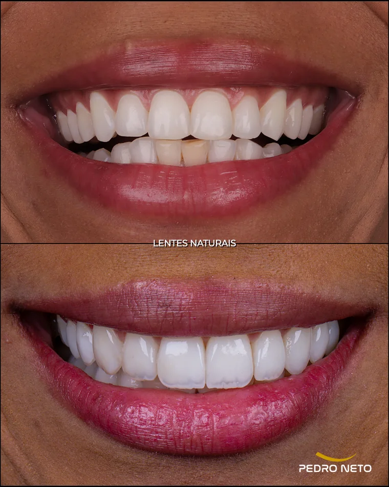 Antes e depois — Dente escurecido, estratificação sobre substrato escuro