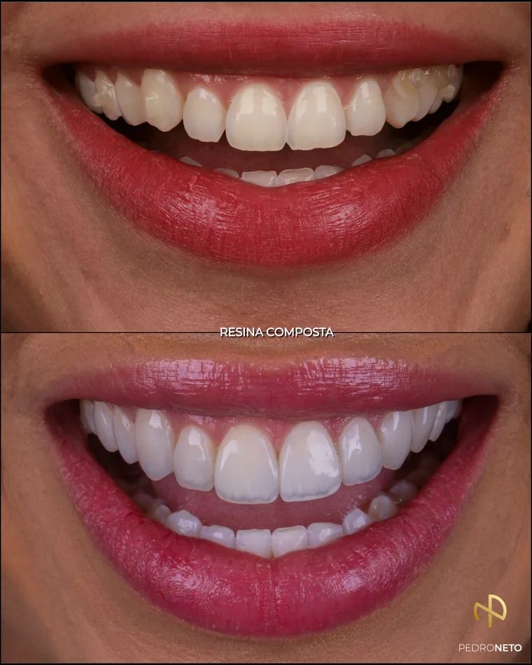 Antes e depois — Pós-ortodontia