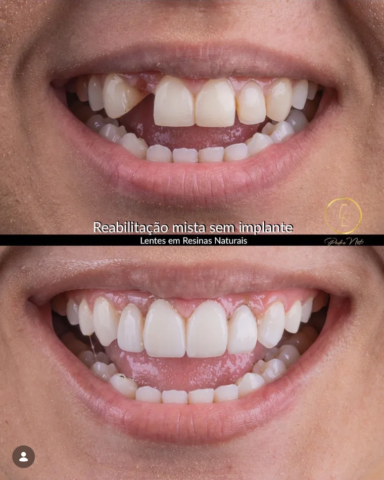Antes e depois — Reabilitação mista