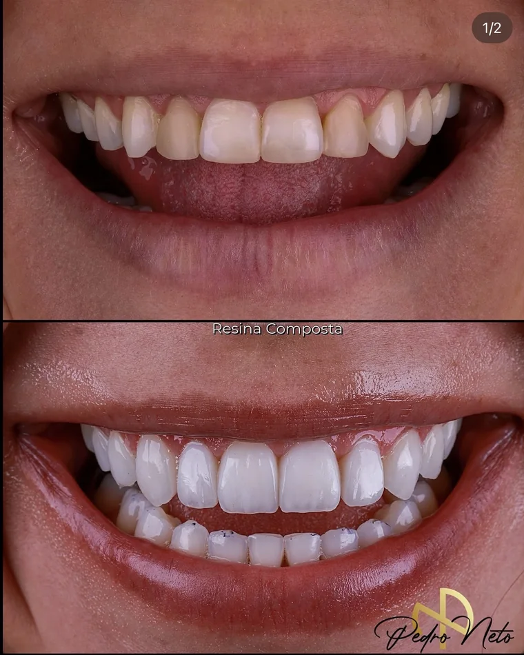 Antes e depois — Troca de resinas antigas