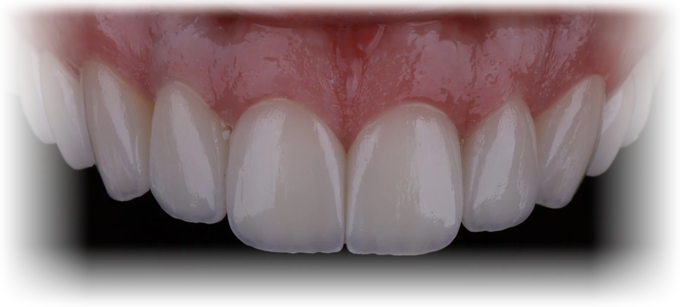 Reabilitação de dentes anteriores superiores em resina composta